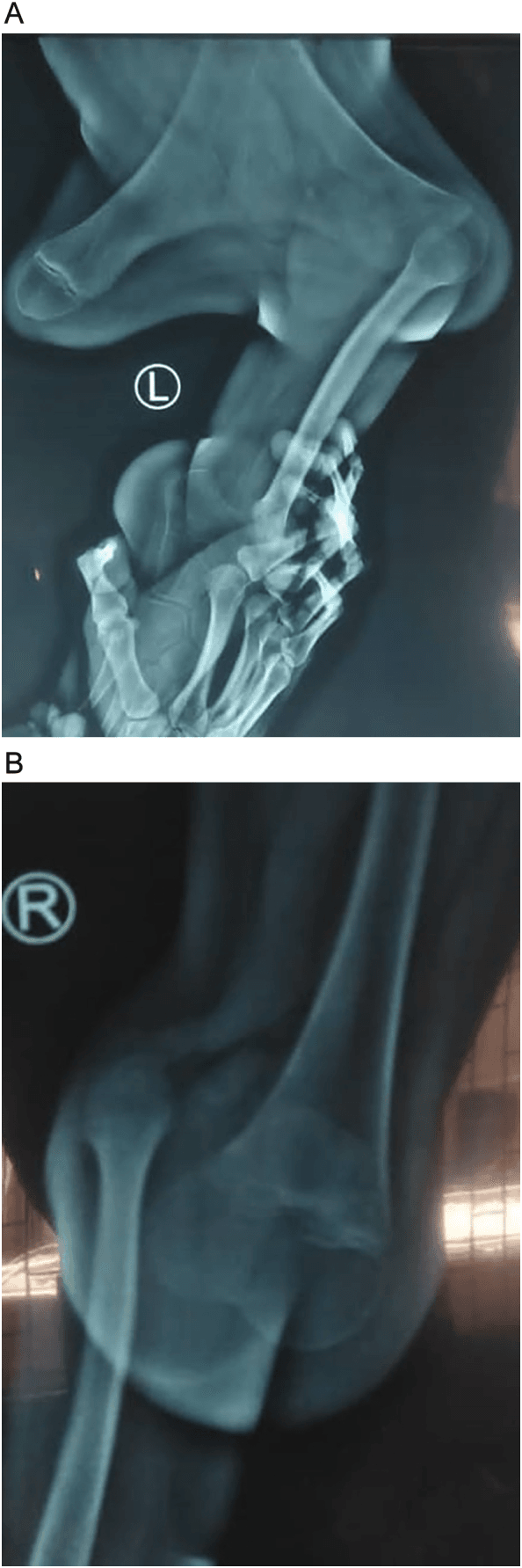 Radiographs of the left (A, marked L) and right (B, marked R) lower limbs from a case report of Gollop-Wolfgang complex in a 12-year-old boy