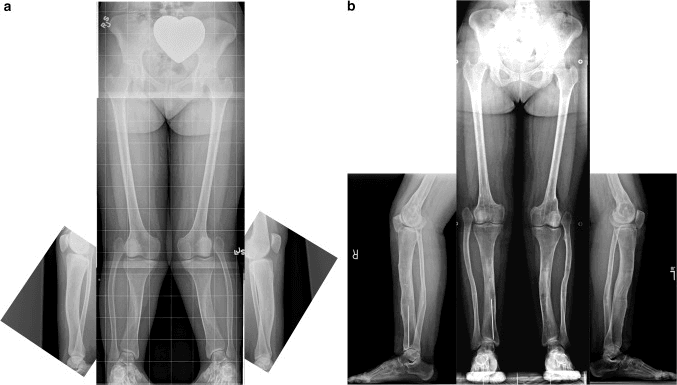 Standing bilateral long-leg radiographs, panels a and b, each with lateral views of both legs, in bilateral Paley Type 1 tibial hemimelia: relatively complete tibiae with proximal fibular overgrowth, valgus and multiplanar tibial deformity
