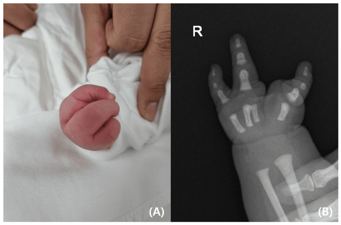 Infant hand photograph (A) and right-hand radiograph (B) showing tetradactylous ectrodactyly, with a central cleft between the digits, in Gollop-Wolfgang complex