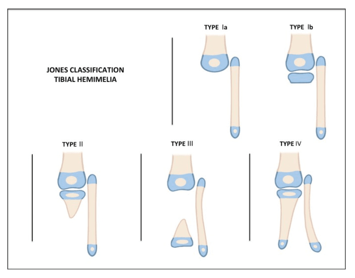 Jones classification diagram of tibial hemimelia: Types Ia, Ib, II, III and IV drawn beneath the distal femur beside the fibula, cartilage shaded blue