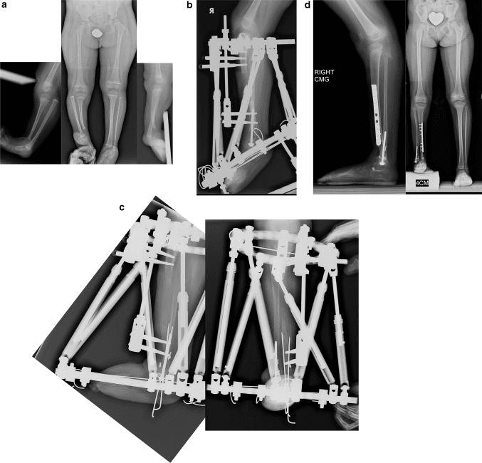 Serial radiographs of Paley Type 2A tibial hemimelia: equinovarus and tibial varus before treatment (a), staged correction and lengthening in circular external fixators (b, c) and later lateral and standing radiographs with a distal plate and a 4 cm block (d)
