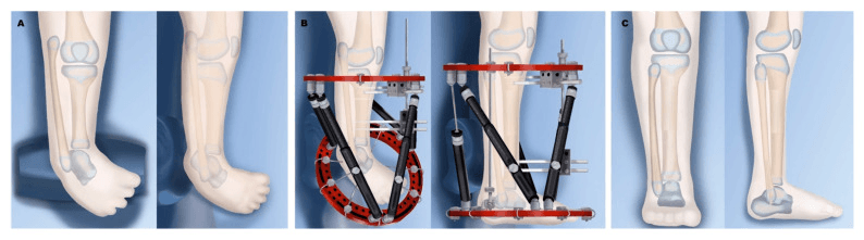 Illustrated Paley Type 2A reconstruction: equinovarus (A), correction with distal fibular transport and tibial lengthening in a circular external fixator (B), and the corrected leg (C)