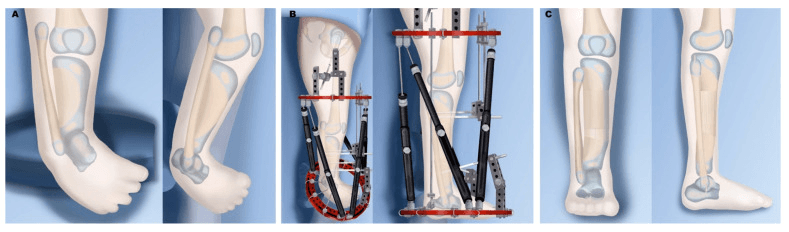 Illustrated Paley Type 2B reconstruction: the deformed leg and foot (A), bracket excision with gradual correction and fibular transport in a circular external fixator (B), and the corrected leg with a plantigrade foot and restored fibular station (C)