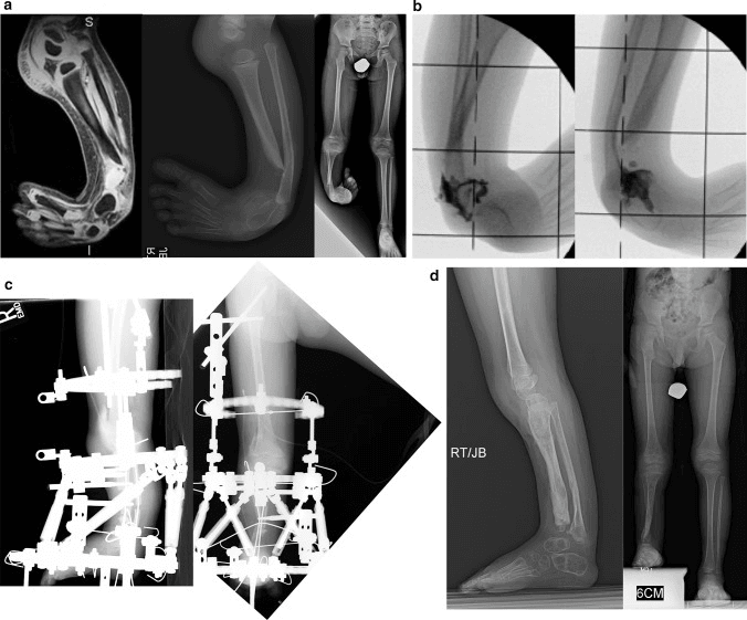 Paley Type 2C tibial hemimelia: MRI and radiographs showing the unossified distal tibial region contiguous with the ankle (a), intraoperative contrast images (b), circular external fixation (c) and later lateral and standing radiographs with a 6 cm block (d)