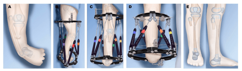 Illustrated Paley Type 4A reconstruction: the deformed leg (A), gradual foot correction and fibular transport in circular external fixators (B-D), and transfer of the fibula to the proximal tibial remnant with physeal-sparing fusion distally (E)