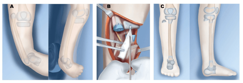 Illustrated Paley Type 4B reconstruction: an unossified proximal tibial anlage (A), the operative exposure (B), and the leg after staged correction and fibular transfer (C)