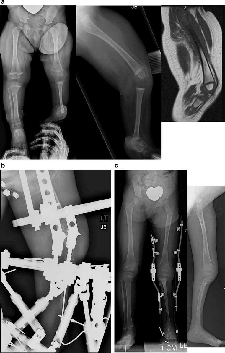 Paley Type 5B tibial hemimelia: radiographs and MRI showing a hypertrophied fibula centred beneath the femur, absent patella and quadriceps continuity to the fibula (a), circular external fixation (b) and later standing and lateral radiographs (c)