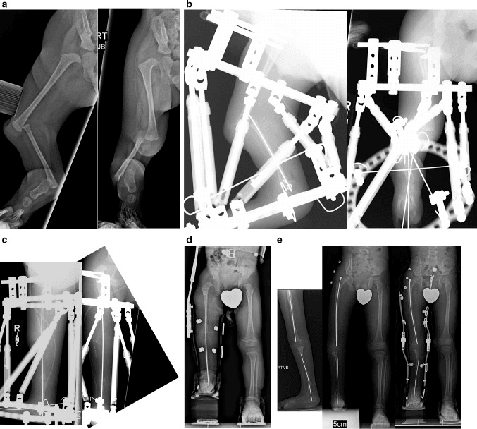 Serial radiographs of Paley Type 5C tibial hemimelia: severe knee and ankle contractures before treatment (a), gradual correction in circular external fixators (b, c) and later standing radiographs with blocks under the foot (d, e)