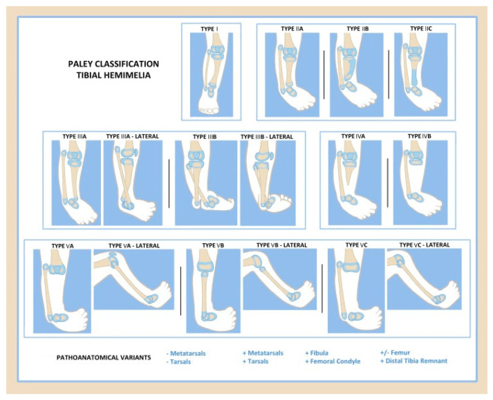 Paley classification diagram of tibial hemimelia: Types I, IIA-IIC, IIIA-IIIB, IVA-IVB and VA-VC, several with lateral views, and a key of pathoanatomical variants