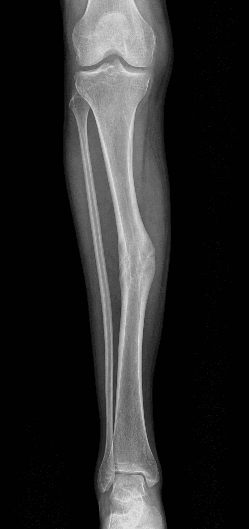 AP radiograph of the leg showing a tibia and fibula with a healed mid-diaphyseal fracture, fusiform callus and cortical thickening at the old fracture site - a tibial malunion.