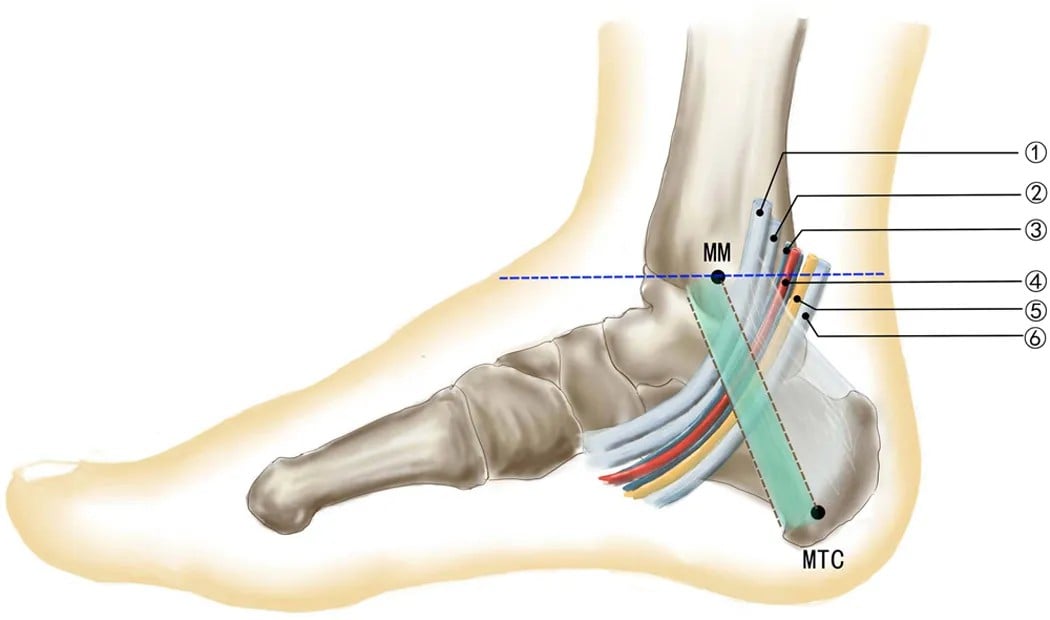 Medial view of the ankle showing the flexor retinaculum spanning the medial malleolus to the calcaneus, with the six tarsal-tunnel structures passing beneath it.