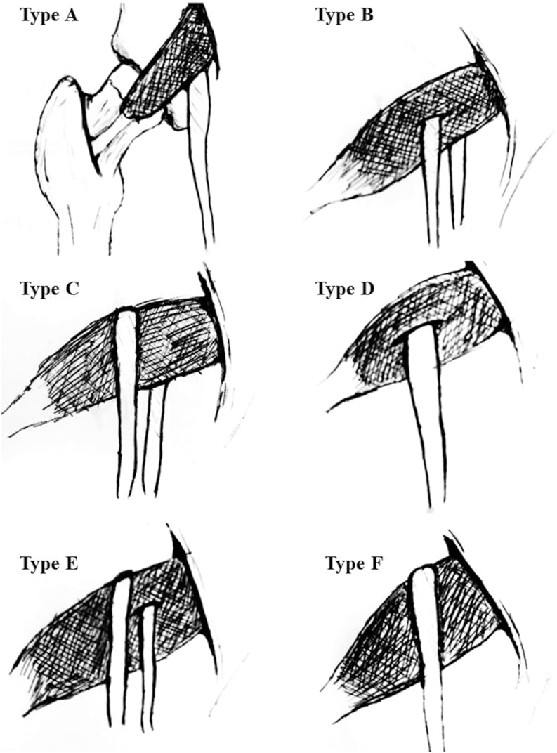 Schematic diagram of Beaton and Anson anatomical variations of the sciatic nerve and piriformis