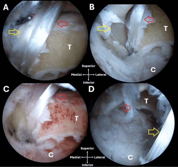 Posterior arthroscopic view showing decompression of the flexor hallucis longus and tibial nerve