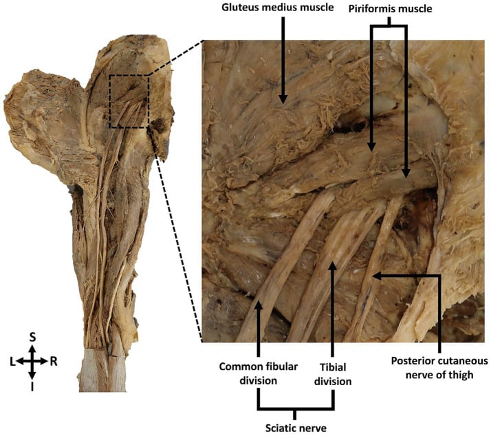 Cadaveric dissection of the left gluteal region showing sciatic nerve bifurcation