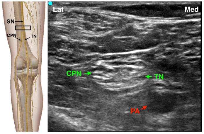 Ultrasound image of popliteal fossa showing tibial nerve, common peroneal nerve and popliteal artery
