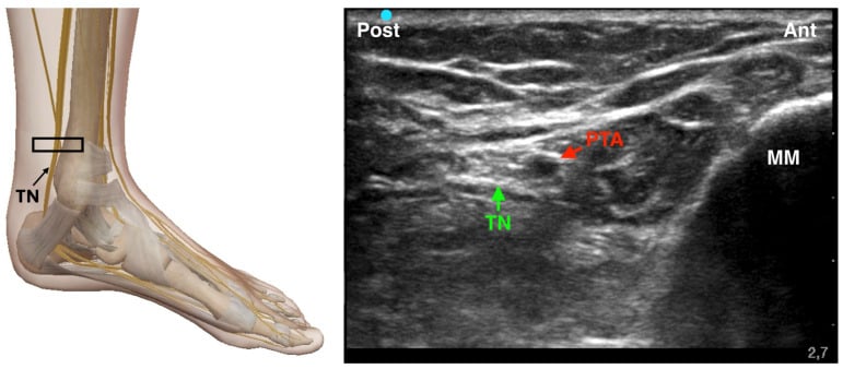 Ultrasound image of ultrasound-guided tibial nerve block posterior to the medial malleolus