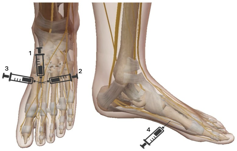 Schematic diagram of ankle nerve block entry points and local anesthetic distribution