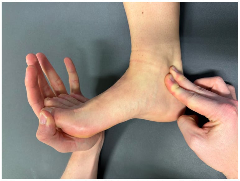 Clinical photograph demonstrating the dorsiflexion-eversion physical exam test for tarsal tunnel syndrome