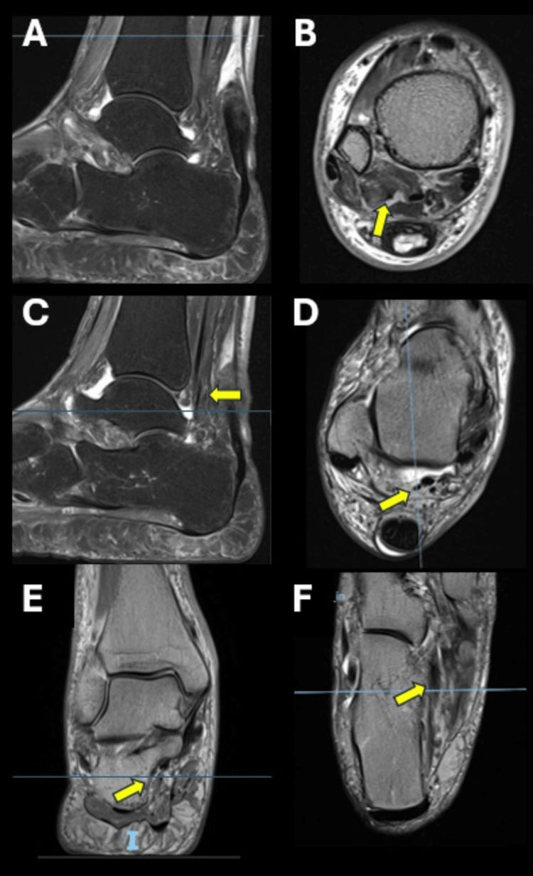 Sagittal, coronal and axial MRI showing tarsal tunnel compression by an accessory muscle