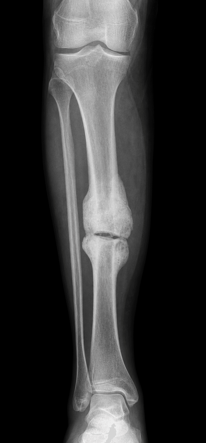 AP leg radiograph showing a hypertrophic tibial nonunion with flared, sclerotic elephant-foot bone ends and a persistent fracture line.