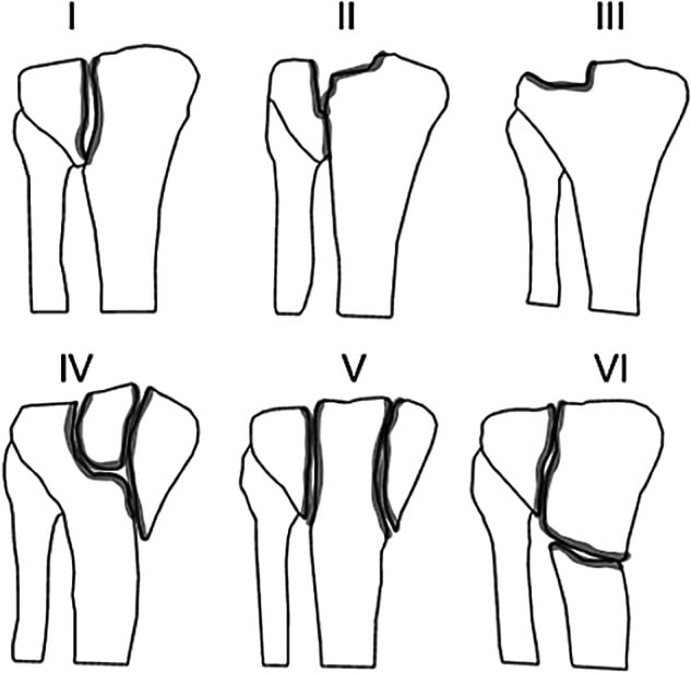 Diagram of the Schatzker classification of tibial plateau fractures, types I to VI