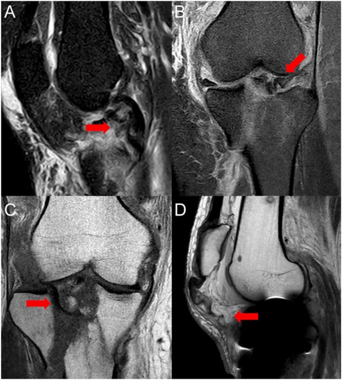 MRI showing bucket-handle meniscus tear and ACL avulsion accompanying a tibial plateau fracture