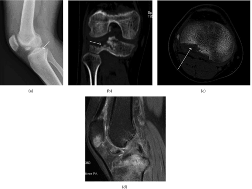 Radiograph, CT and 3D reconstruction of a posterolateral tibial plateau fracture