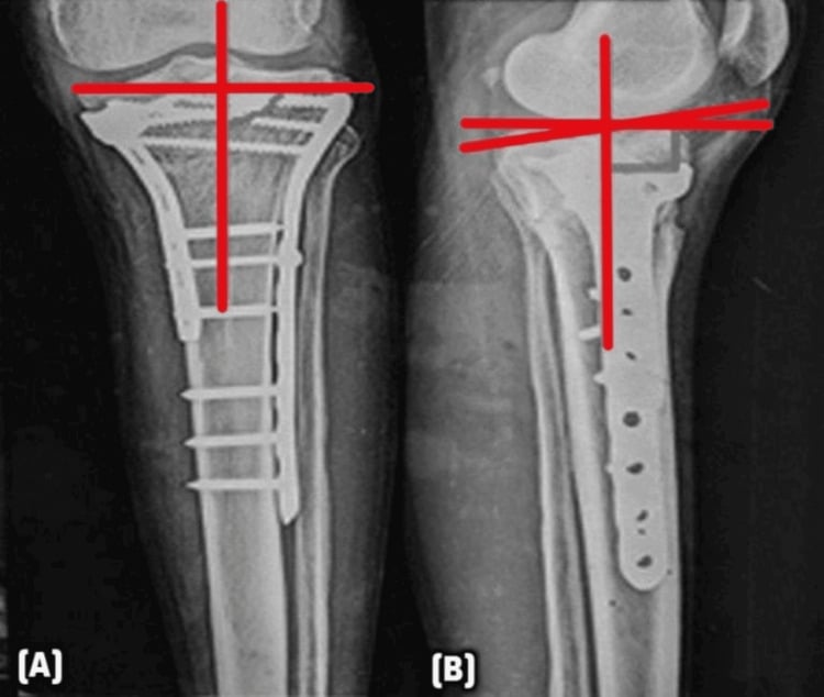 Postoperative radiographs with medial proximal tibial angle and posterior proximal tibial angle measured
