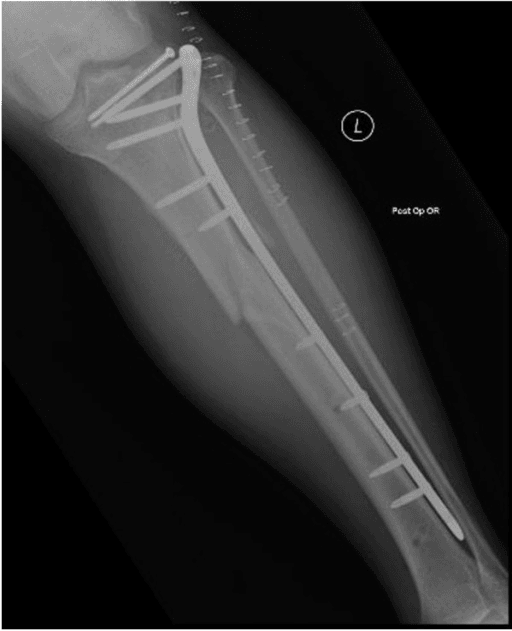 Postoperative lateral radiograph following fixation of a tibial plateau fracture