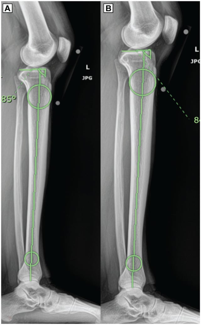 Full-length lateral radiograph showing measurement of posterior tibial slope