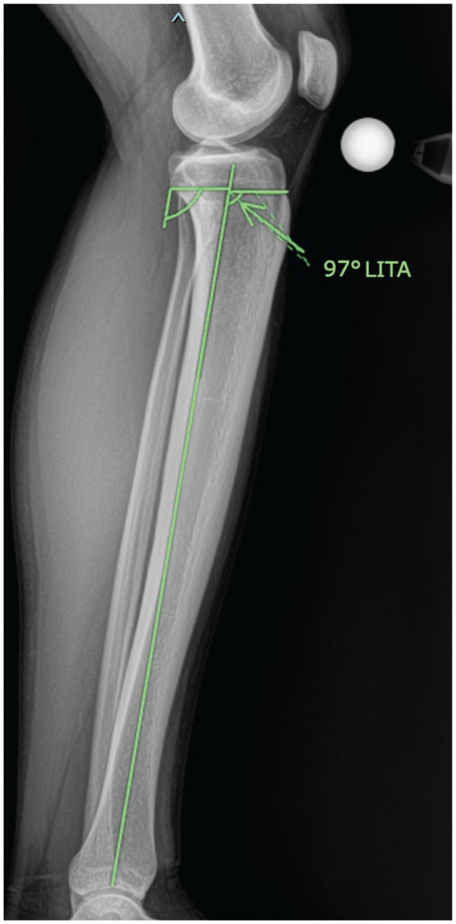 Full-length lateral radiograph showing measurement of the lateral inclination of the tibial axis