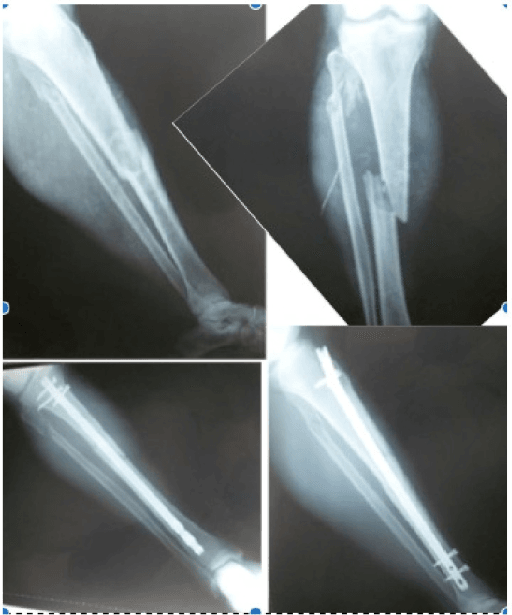 Anteroposterior and lateral X-ray images showing a middle one-third tibial shaft fracture with an associated fibular fracture and a healed tibial fracture treated with intramedullary nailing.