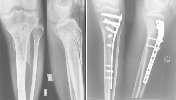 Preoperative and postoperative radiographs of tibial shaft fracture plating