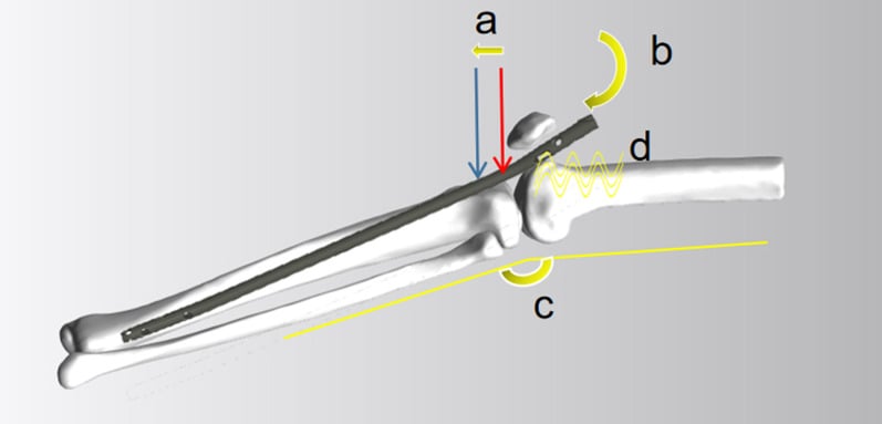 3D anatomical diagram illustrating suprapatellar tibial nailing entry trajectory