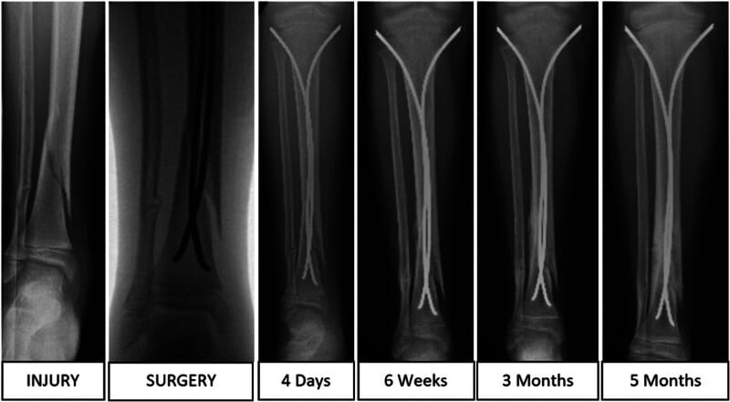 Serial AP radiographs demonstrating progressive tibial shaft fracture healing over 5 months
