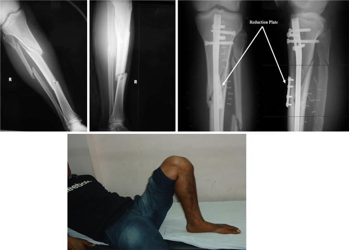 Preoperative and postoperative radiographs of segmental tibial shaft fracture intramedullary nailing