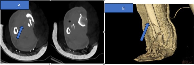 CT angiography 3D reconstruction and axial CT of leg demonstrating tibial arterial injury