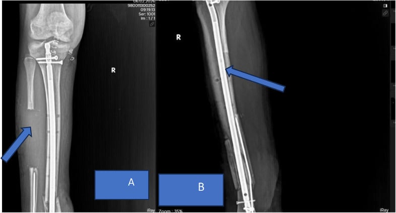 Postoperative radiograph of tibial intramedullary nailing with fibular strut graft