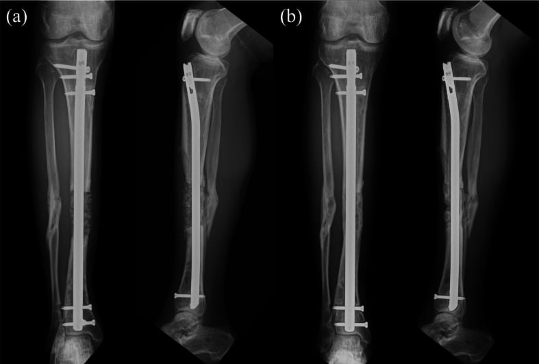 Radiographs of bone grafting for tibial shaft defect at initial surgery and 10-month follow-up