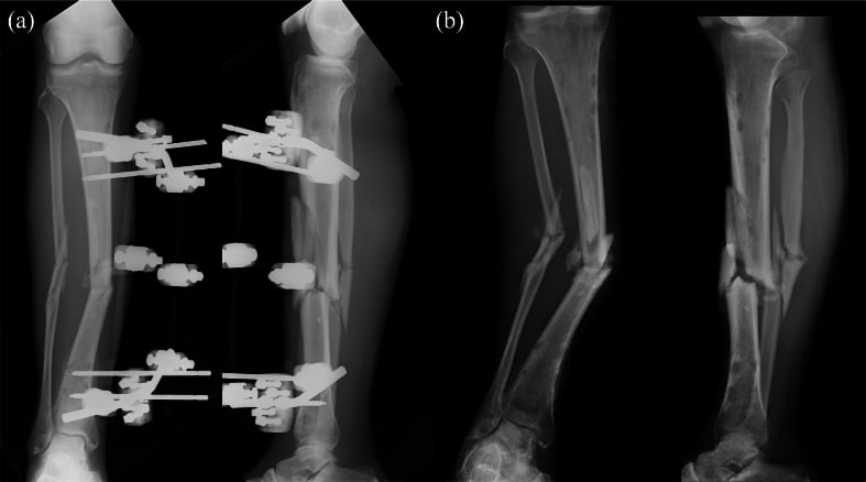 Radiographs of temporary spanning external fixator for open tibial shaft fracture