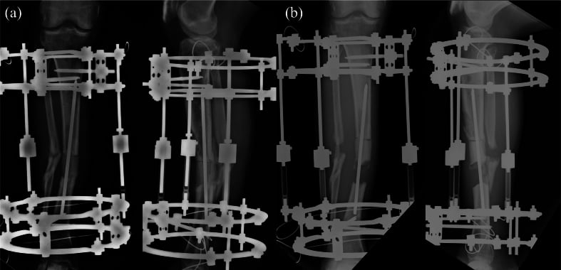 Radiographs of Ilizarov ring fixator for tibial deformity correction