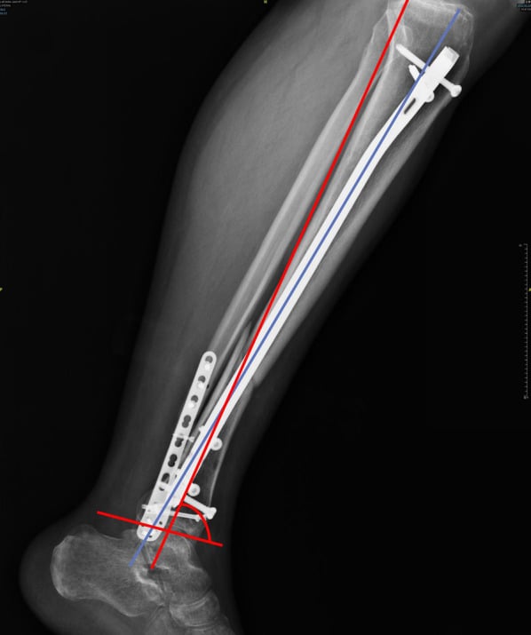 Lateral radiograph demonstrating intramedullary nail entry trajectory and axis lines