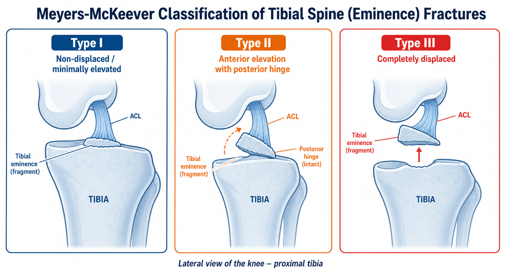 Meyers-McKeever classification of tibial spine fractures