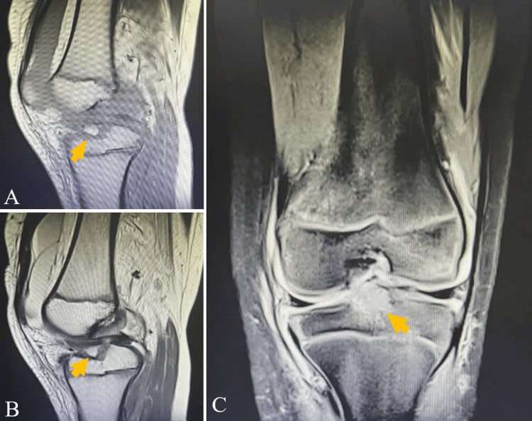 Sagittal (A, B) and coronal (C) MRI with arrows marking an avulsed tibial eminence fragment at the ACL insertion