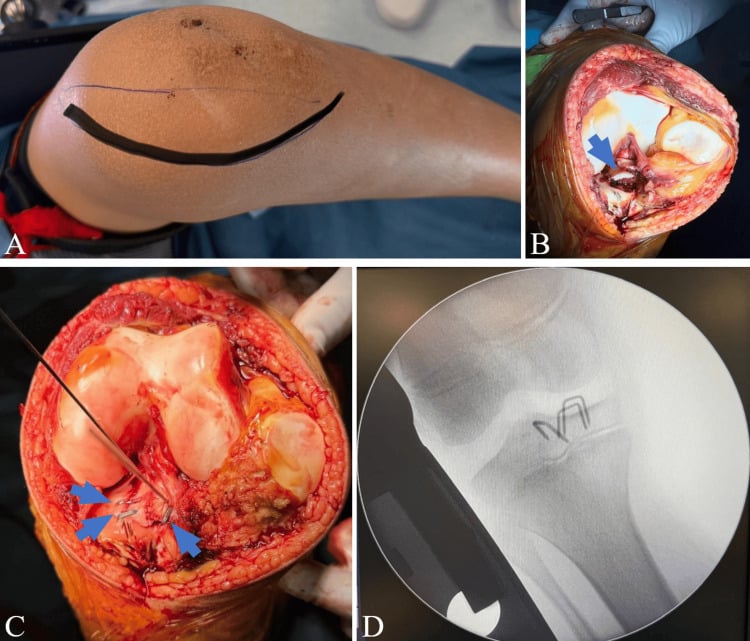 Open reduction and staple fixation of a displaced tibial-spine avulsion