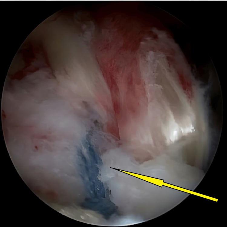 Arthroscopic view of tibial-spine fragment fixation with sutures tensioned into a knotless anchor