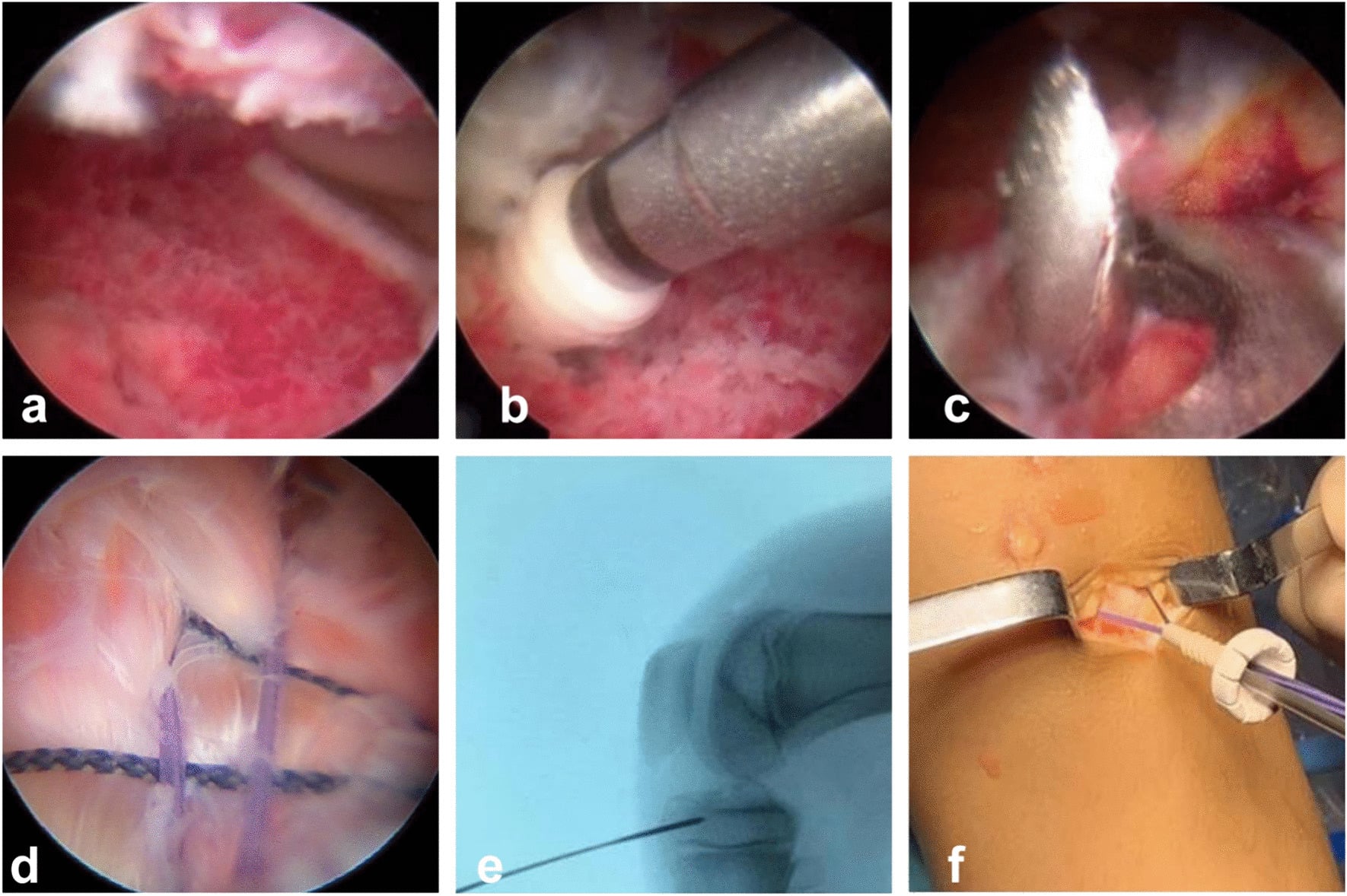 Modified arthroscopic suture-bridge fixation sequence for paediatric tibial eminence avulsion