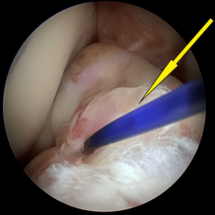 Arthroscopic lasso around the ACL to assist tibial-spine fragment reduction