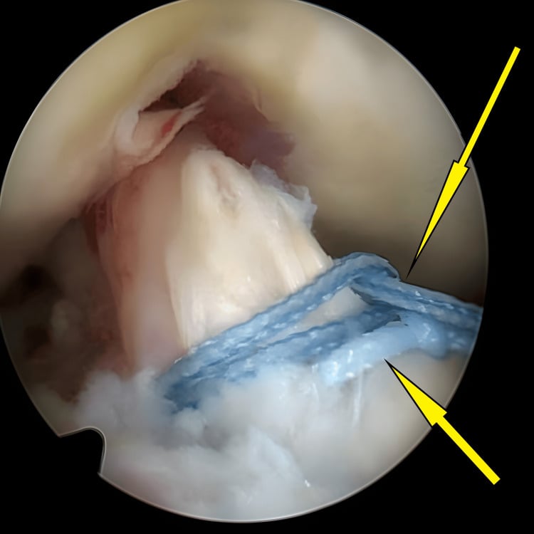 Final crossed-suture compression over a reduced tibial-spine fragment