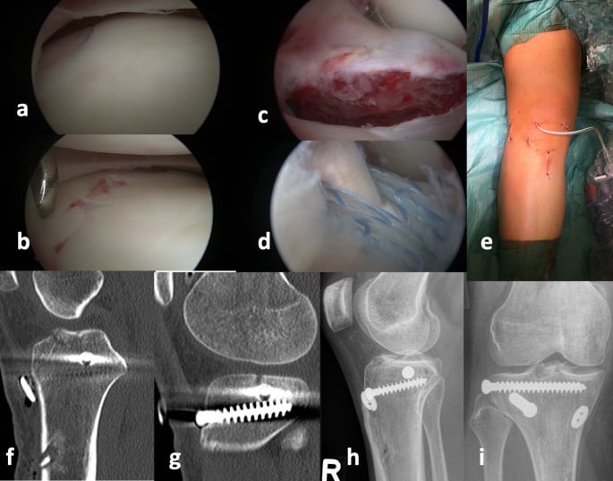 Combined tibial eminence avulsion and posterolateral plateau impression treated arthroscopically